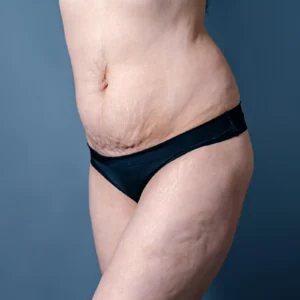 Skóra po operacji bariatrycznej